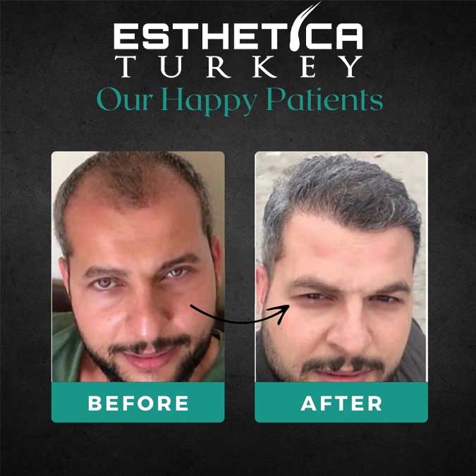 Hair transplant result