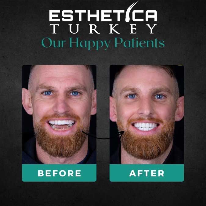 Hair transplant result