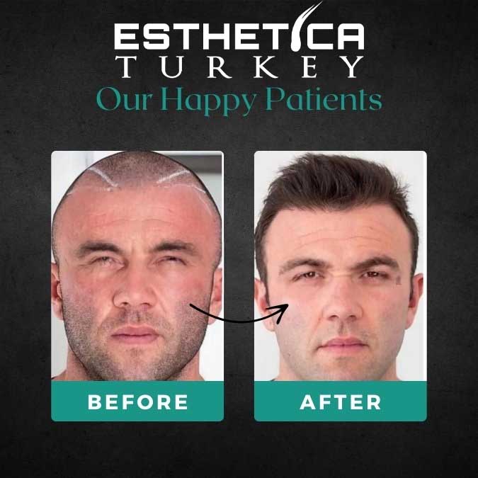 Hair transplant result