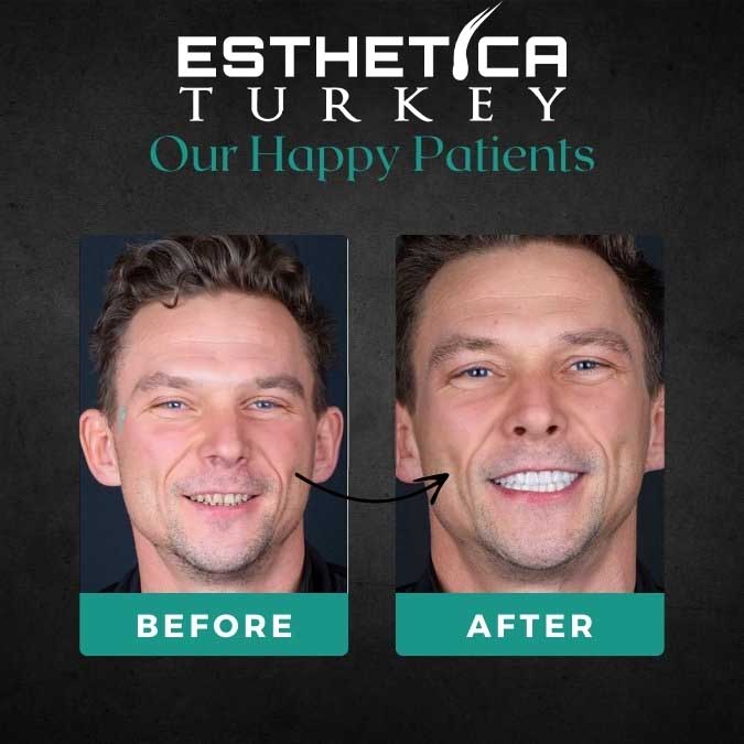Hair transplant result