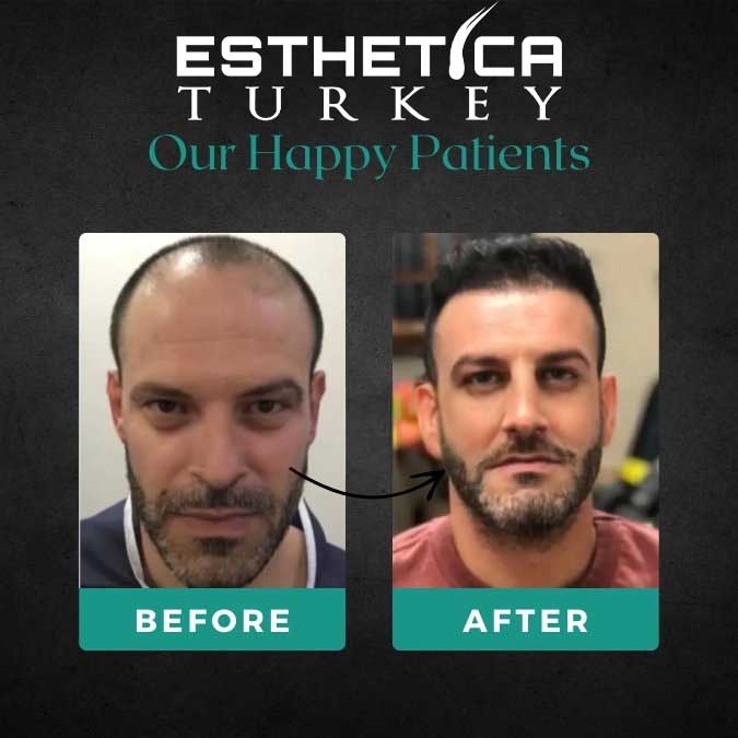 Hollywood smile result